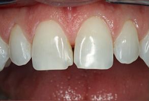 Premier Dental | Dental Bridges, Extractions and All-on-6 reg